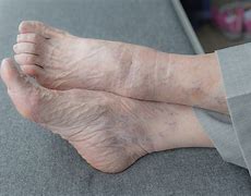 Image result for Senior Citizen Feet