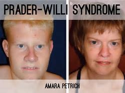 Image result for Symptoms of Prader-Willi Syndrome