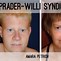 Image result for Prayder Willi Disease