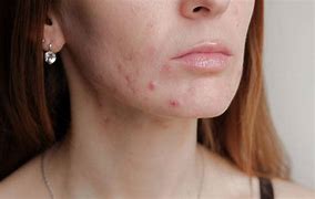 Image result for Blemish Meaning