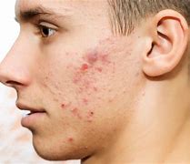 Image result for How to Get Rid of Cystic Acne