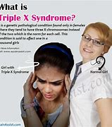 Image result for Trisomy X Syndrome Symptoms