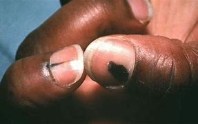 Image result for Melanoma Cancer in Black People