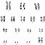 Image result for Karyotype for Klinefelter's Syndrome