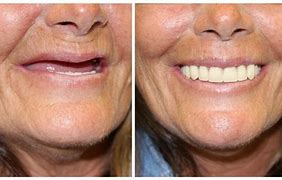 Image result for Before and After Dentures