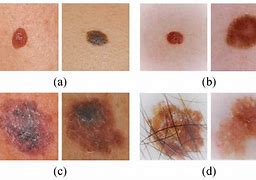 Image result for Late Stages of Melanoma