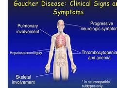 Image result for Gaucher Type 2