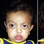 Image result for Mild Crouzon Syndrome