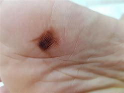 Image result for Stage 4 Melanoma On Foot
