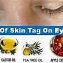 Image result for Cluster Like Skin Tag On Eyelid