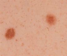 Image result for Pic of Stage 1 Melanoma