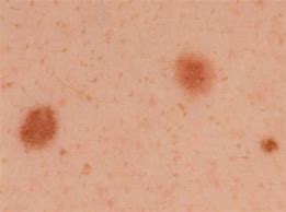 Image result for Stage 1 Melanoma Skin Cancer