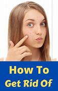 Image result for How to Get Rid of Beach Pimples