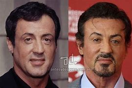 Image result for Sylvester Stallone Plastic Surgery Gone Bad