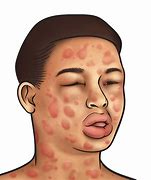 Image result for Anaphylaxis