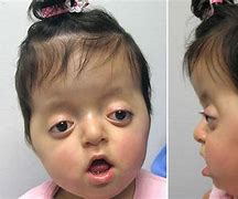 Image result for Pfeiffer Syndrome Diagnosis