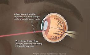 Image result for Glaucoma Procedure