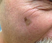 Image result for Melanoma On Black Skin