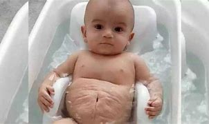 Image result for Prune Belly Syndrome