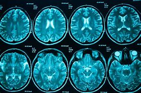 Image result for CT brain scans