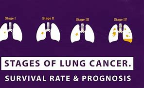 Image result for Prognosis. Stage Iiib Lung Cancer