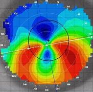 Image result for Pellucid Corneal Topography