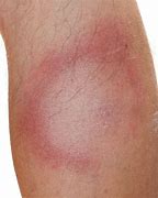 Image result for Skin Blemishes On Legs