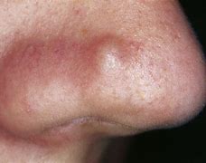 Image result for Nose Blemish