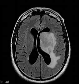 Image result for .CNS Lymphoma
