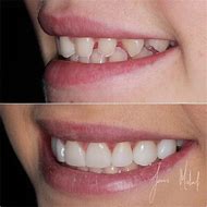 Image result for Composite Veneers Before and After