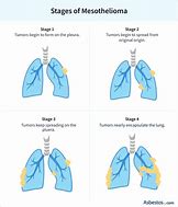 Image result for Mesothelioma Staging
