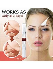 Image result for How to Remove Skin Tags