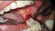 Horizontal Impacted Wisdom Tooth - Sonic Surgery - Dr. Fabio Cozzolino | Zerodonto
