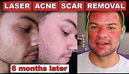 Acne Scar Removal Before And After 6 Months: Fractional C02 Laser Skin Resurfacing
