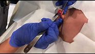 Keloid Removal (Ear) - Dr. Johnson C. Lee, MD Plastic Surgery