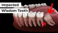 Impacted Wisdom Tooth Removal