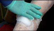 How To Change A Wound Dressing
