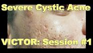 Severe Cystic Acne - Victor: Session #1