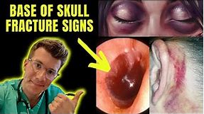 Clinical Signs of Base of Skull Fracture - including Racoon eyes, Battle's Sign & more!