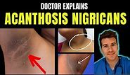 Doctor explains Acanthosis Nigricans - signs, symptoms, causes, treatment and more!