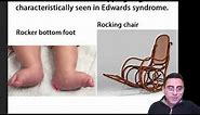 Edward Syndrome - explained simply