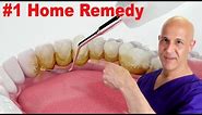 #1 Home Remedy to Remove Dental Plaque & Tarter to Prevent Cavities | Dr. Mandell