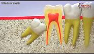 All you need to know about the eruption of a wisdom tooth
