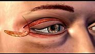 Cosmetic Eye and Eyelid Surgery - 3D Medical Animation || ABP ©