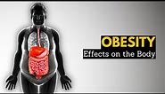 Obesity, Causes, SIgns and Symptoms, Diagnosis and Treatment.