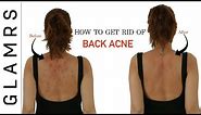How To Get Rid of Back Acne the Natural Way | Effective Home Remedies