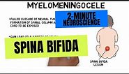 2-Minute Neuroscience: Spina Bifida
