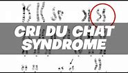 Cri Du Chat Syndrome (CdCS or 5p-) - Genetics | Medicine