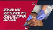 SURGICAL ACNE SCAR REMOVAL WITH PUNCH EXCISION FOR DEEP SCARS | Dr. Jason Emer
