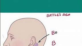 Battle's Sign - mnemonic | Forensic Medicine, ENT, Surgery | #shorts